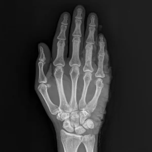 Hand X-ray_ carpal tunnel - extremity care Sarasota, FL