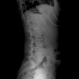 Spine X-ray - Scoliosis - chiropractic Care Sarasota, FL