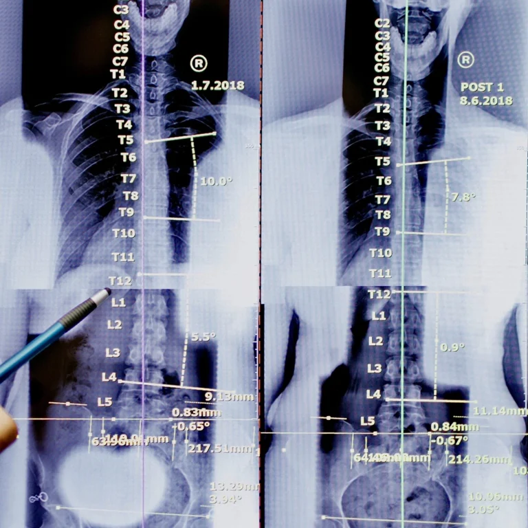 spinal x-rays SARASOTA’S POSTURE SPECIALIST