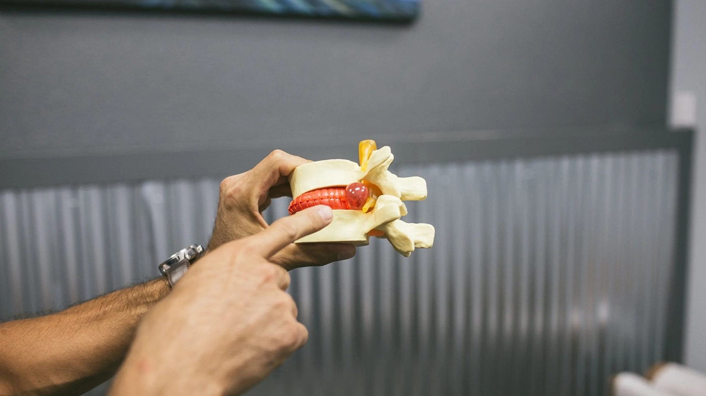 Disc protrusions, also known as a bulging disc or herniated disc