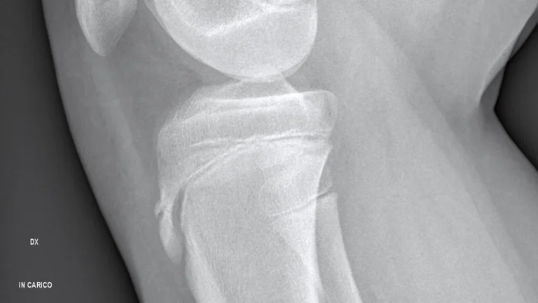 Osgood-Schlatter’s Disease: Understanding Knee Pain in Active Kids and Teens in Sarasota