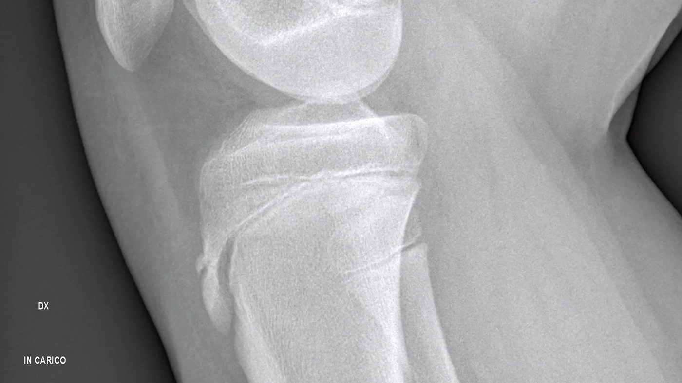Osgood-Schlatter’s Disease: Understanding Knee Pain in Active Kids and Teens in Sarasota