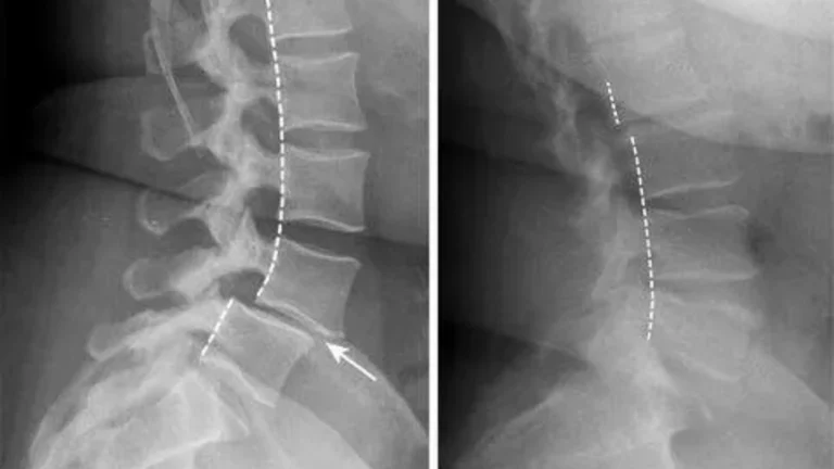 What Is Spondylolisthesis and Can Chiropractic Help? - back pain