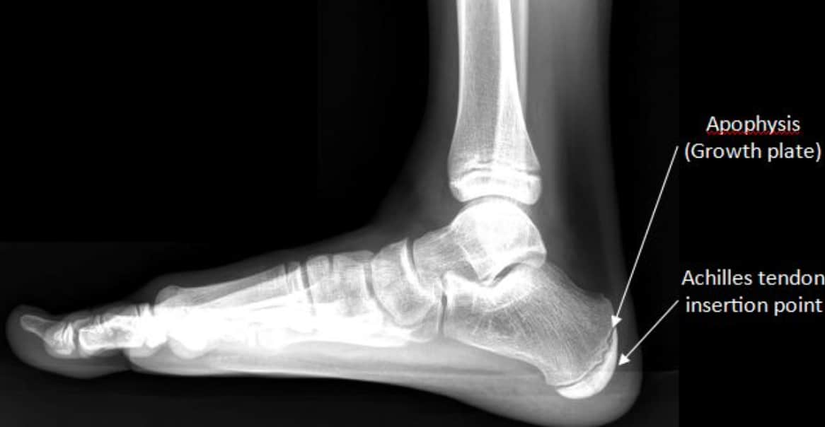 Diagram of a child's foot highlighting Sever’s Disease inflammation at the heel growth plate and Achilles tendon tension.